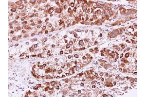 IHC-P Image RAB2B antibody detects RAB2B protein at cytoplasm and membrane on human liver carcinoma by immunohistochemical analysis. (RAB2B Antikörper)