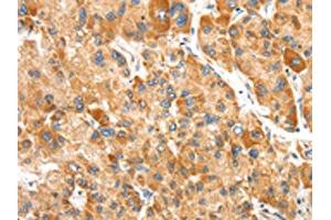 The image on the left is immunohistochemistry of paraffin-embedded Human liver cancer tissue using ABIN7192438(SLC24A6 Antibody) at dilution 1/20, on the right is treated with synthetic peptide. (SLC24A6 Antikörper)