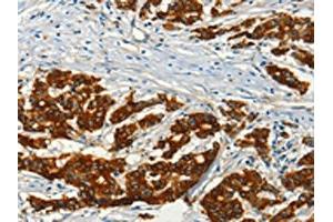 The image on the left is immunohistochemistry of paraffin-embedded Human colon cancer tissue using ABIN7128251(ADCY3 Antibody) at dilution 1/50, on the right is treated with fusion protein. (ADCY3 Antikörper)