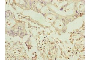 Immunohistochemistry of paraffin-embedded human pancreatic cancer using ABIN7159917 at dilution of 1:100 (TOMM34 Antikörper  (AA 1-309))