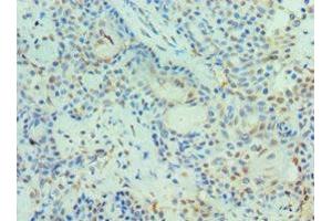 Immunohistochemistry of paraffin-embedded human breast cancer using ABIN7150969 at dilution of 1:100 (PIAS3 Antikörper  (AA 399-628))