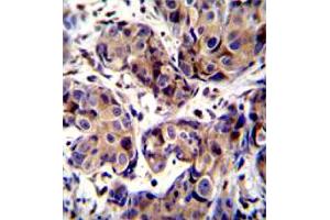 Immunohistochemistry (Formalin/PFA-fixed paraffin-embedded sections) of human breast cancer tissue withMAGEA3 polyclonal antibody . (MAGEA3 Antikörper  (AA 283-314))