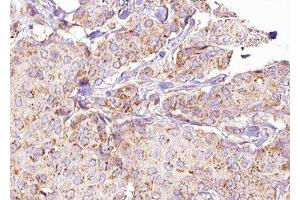 ABIN6276290 at 1/100 staining Human breast cancer tissue by IHC-P. (ATG5 Antikörper  (C-Term))