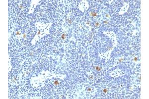 Formalin-fixed, paraffin-embedded human Cervix stained with HPV-16 Mouse Monoclonal Antibody (HPV16/1295). (HPV16 Antikörper)