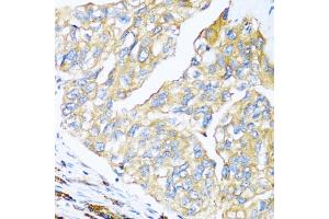 Immunohistochemistry of paraffin-embedded human prostate cancer using MANF antibody (ABIN6291535) at dilution of 1:100 (40x lens). (MANF Antikörper)