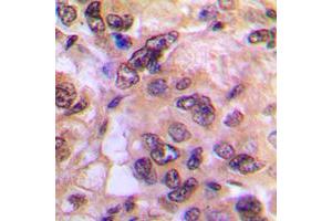 Immunohistochemical analysis of PKA C alpha/beta staining in human breast cancer formalin fixed paraffin embedded tissue section. (PKA/C alpha/beta (N-Term) Antikörper)