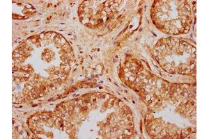 IHC image of ABIN7175133 diluted at 1:300 and staining in paraffin-embedded human prostate cancer performed on a Leica BondTM system. (UMODL1 Antikörper  (AA 537-654))