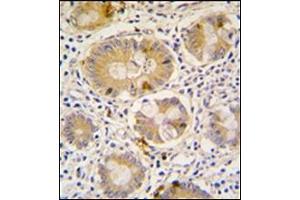 Formalin-Fixed, Paraffin-Embedded human colon carcinoma tissue reacted with Autophagy APG16L antibody (C-term), which was peroxidase-conjugated to the secondary antibody, followed by DAB staining. (ATG16L1 Antikörper  (C-Term))