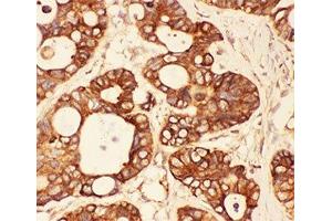 IHC-P: Src antibody testing of human intestinal cancer tissue (Src Antikörper  (AA 2-368))