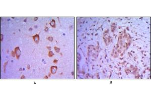 Immunohistochemical analysis of paraffin-embedded human brain tissue (A) and breast tumor (B) uing ETS1 mouse mAb. (ETS1 Antikörper)