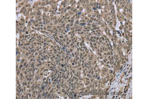 Immunohistochemistry of Human breast cancer using DCTN4 Polyclonal Antibody at dilution of 1:30 (Dynactin 4 Antikörper)