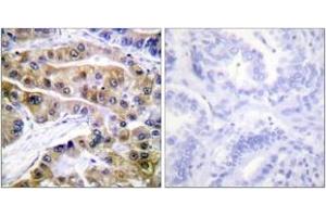Immunohistochemistry analysis of paraffin-embedded human lung carcinoma, using ATPase (Phospho-Ser16) Antibody.