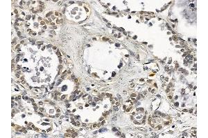 DDIT3/CHOP Mouse Monoclonal Antibody at 1/100 staining human ovarian cancer by IHC-P.