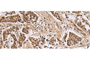 Immunohistochemistry of paraffin-embedded Human breast cancer tissue using DNA2 Polyclonal Antibody at dilution of 1:40(x200)