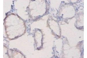 Immunohistochemistry of paraffin-embedded human colon cancer using ABIN7163695 at dilution of 1:20 (Plexin A1 Antikörper  (AA 32-296))