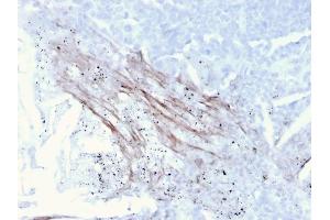 Formalin-fixed, paraffin-embedded human Lung Carcinoma stained with Tenascin C Mouse Recombinant Monoclonal Antibody (TNC/3635). (Rekombinanter TNC Antikörper)
