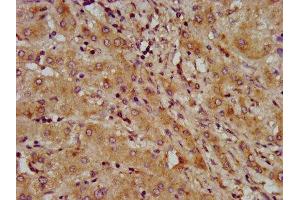 IHC image of ABIN7158792 diluted at 1:600 and staining in paraffin-embedded human liver cancer performed on a Leica BondTM system. (LAPTM4B Antikörper  (AA 174-226))