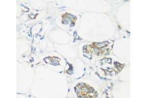 Immunohistochemistry of paraffin-embedded Human mammary cancer using NMT1 Polyclonal Antibody at dilution of 1:100 (40x lens). (NMT1 Antikörper)