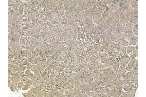 ABIN6256505 and ABIN6267159 at 1/100 staining human hepatocellular carcinoma by IHC-P. (PLK1 Antikörper  (pThr210))