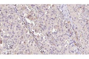 ABIN6273313 at 1/100 staining Human thyroid cancer tissue by IHC-P. (SAT1 Antikörper  (C-Term))