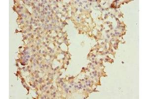 Immunohistochemistry of paraffin-embedded human breast cancer using ABIN7145623 at dilution of 1:100 (NUDT2 Antikörper  (AA 1-147))
