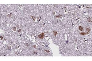 ABIN6276299 at 1/100 staining Human brain cancer tissue by IHC-P. (Caspase 10 Antikörper)