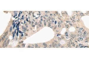 Immunohistochemistry of paraffin-embedded Human colorectal cancer tissue using ETV4 Polyclonal Antibody at dilution of 1:25(x200) (ETV4 Antikörper)