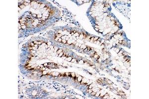 IHC-P: IGF2R antibody testing of human intestine cancer tissue