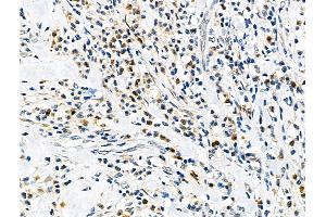 ABIN6258629 and ABIN6275742 at 1/100 staining Human esophageal cancer by IHC-P. (Elf4 Antikörper  (Internal Region))