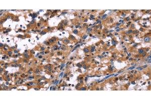 Immunohistochemistry of paraffin-embedded Human thyroid cancer tissue using R3HCC1L Polyclonal Antibody at dilution 1:40 (GIDRP88 Antikörper)