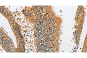 Immunohistochemistry of paraffin-embedded Human colon cancer tissue using ARHGAP5 Polyclonal Antibody at dilution 1:30 (ARHGAP5 Antikörper)
