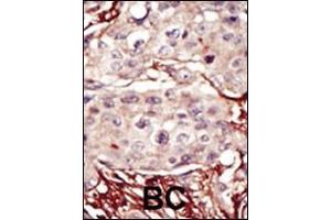 Formalin-fixed and paraffin-embedded human cancer tissue reacted with the primary antibody, which was peroxidase-conjugated to the secondary antibody, followed by DAB staining. (Aurora-B (ARK/STK12) (AA 283-313) Antikörper)