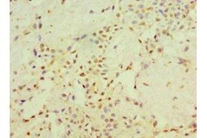 Immunohistochemistry of paraffin-embedded human breast cancer using ABIN7170704 at dilution of 1:100 (STARD3 Antikörper  (AA 170-445))