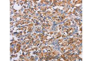 Immunohistochemistry of Human thyroid cancer using PIM2 Polyclonal Antibody at dilution of 1:40