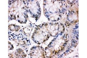 IHC-P: MCM5 antibody testing of human intestinal cancer tissue (MCM5 Antikörper  (C-Term))