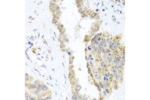 Immunohistochemistry of paraffin-embedded human lung cancer using DARS2 antibody. (DARS2 Antikörper  (AA 406-645))