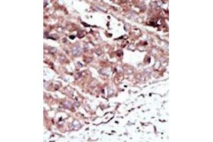 Formalin-fixed and paraffin-embedded human cancer tissue (hepatocarcinoma) reacted with the primary antibody, which was peroxidase-conjugated to the secondary antibody, followed by AEC staining. (PHKG2 Antikörper  (N-Term))