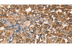 Immunohistochemistry of paraffin-embedded Human thyroid cancer tissue using AGO1 Polyclonal Antibody at dilution 1:40 (AGO1 Antikörper)