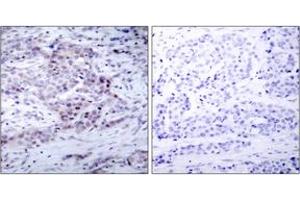 Immunohistochemistry analysis of paraffin-embedded human breast carcinoma, using NF-kappaB p100/p52 (Phospho-Ser869) Antibody. (NFKB2 Antikörper  (pSer870))