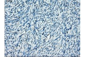 Immunohistochemical staining of paraffin-embedded Adenocarcinoma of breast tissue using anti-SSX2 mouse monoclonal antibody. (SSX2 Antikörper)