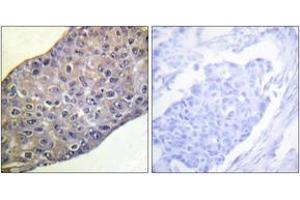 Immunohistochemistry analysis of paraffin-embedded human breast carcinoma tissue, using RhoA (Ab-188) Antibody. (RHOA Antikörper  (AA 144-193))