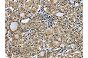 The image on the left is immunohistochemistry of paraffin-embedded Human thyroid cancer tissue using ABIN7131308(TBL1Y Antibody) at dilution 1/20, on the right is treated with fusion protein.