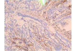 Staining of frozen tissue sections of colon carcinoma using SSEA-4 F8 antibody (Rekombinanter SSEA-4 Antikörper)
