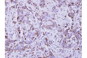 IHC-P Image Immunohistochemical analysis of paraffin-embedded human breast cancer, using Interferon gamma Receptor 1, antibody at 1:250 dilution. (IFNGR1 Antikörper)