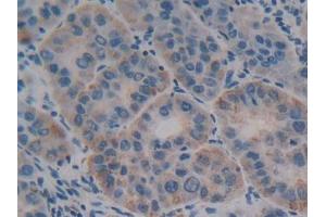 DAB staining on IHC-P; Samples: Human Liver cancer Tissue (Olfactomedin 4 Antikörper  (AA 407-510))