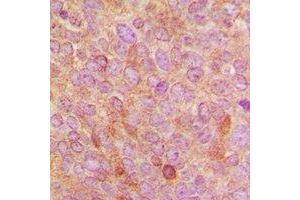 Immunohistochemical analysis of Cytochrome P450 24A1 staining in human breast cancer formalin fixed paraffin embedded tissue section. (CYP24A1 Antikörper  (C-Term))
