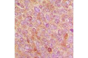 Immunohistochemical analysis of Cytochrome P450 24A1 staining in human breast cancer formalin fixed paraffin embedded tissue section.