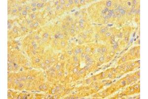 Immunohistochemistry of paraffin-embedded human liver cancer using ABIN7149270 at dilution of 1:100