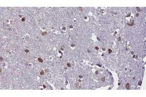 ABIN6268871 at 1/100 staining Human brain cancer tissue by IHC-P. (beta Synuclein Antikörper  (C-Term))