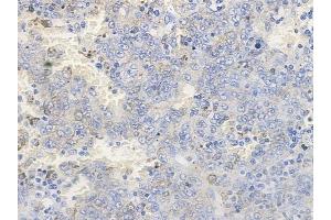 ABIN6256596 and ABIN6267259 at 1/100 staining human melanoma by IHC-P. (EGFR Antikörper  (pThr669, pTyr693))
